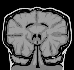 Trrarrusian mri scan.jpg